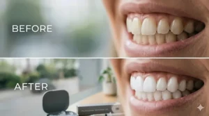Side-by-side comparison of teeth before and after using a professional custom-fit whitening treatment.