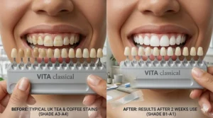 A before and after comparison showing the transition from tea-stained teeth to a brighter shade using whitening strips over two weeks.