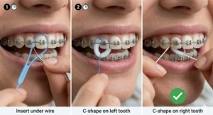 An anatomical diagram of a tooth with braces, featuring red highlights that identify plaque accumulation sites around the bracket, under the wire, and at the gumline.