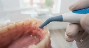 Step-by-step demonstration on how to correctly angle a rubber tip stimulator along the gumline.